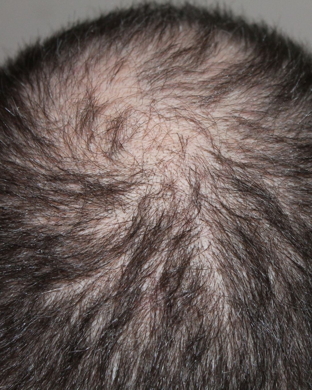 Manejo de alopecia